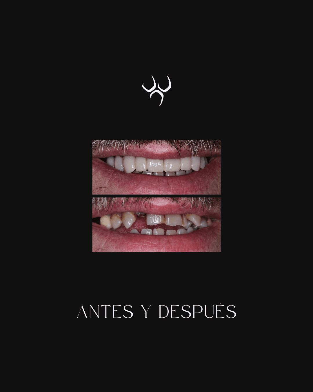 Antes y después de un tratamiento dental para ILC Dental